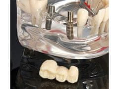 Verk 01964_B Model zubních implantátů bílá