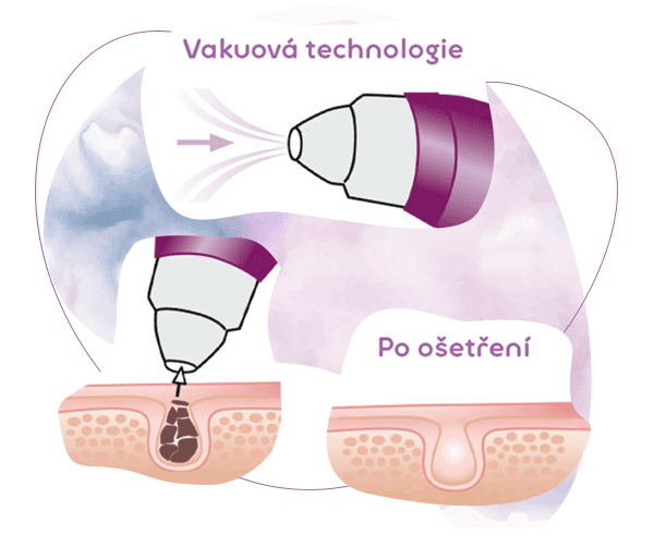 Beurer FC 41 profesionální exfoliace obličeje